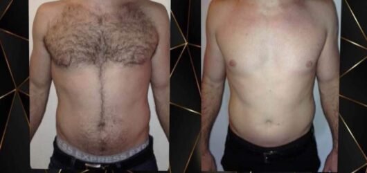Den Ultimative Guide til Laser Hårfjerning i København: Det Skal du Vide Før Din Første Behandling