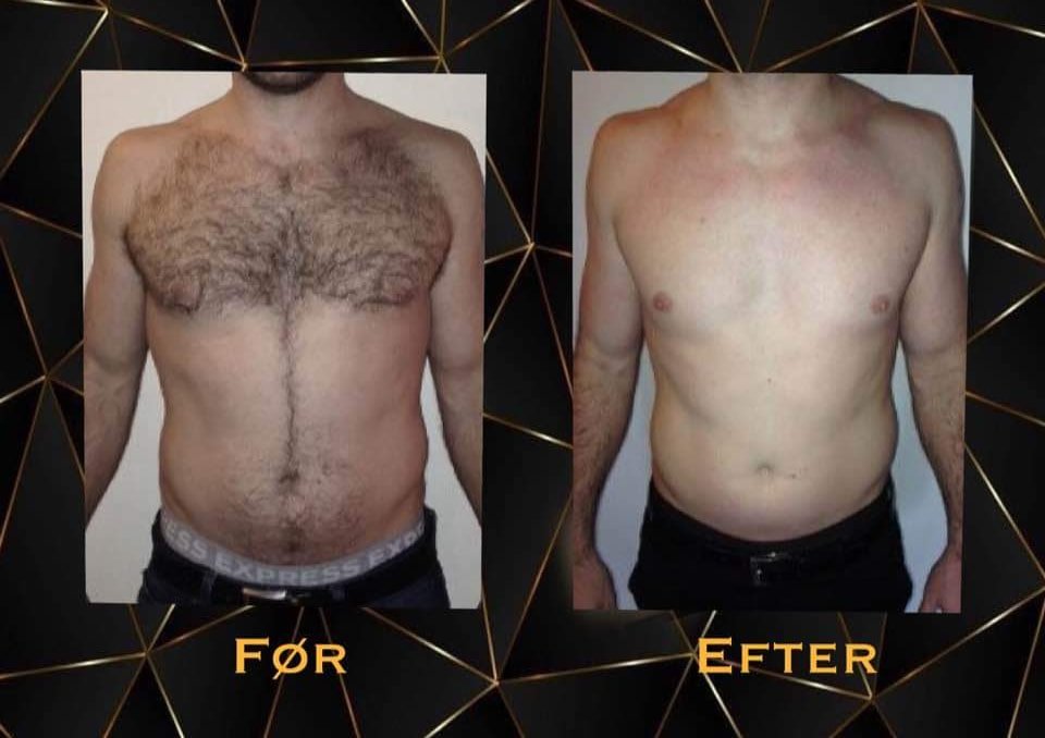 Den Ultimative Guide til Laser Hårfjerning i København: Det Skal du Vide Før Din Første Behandling